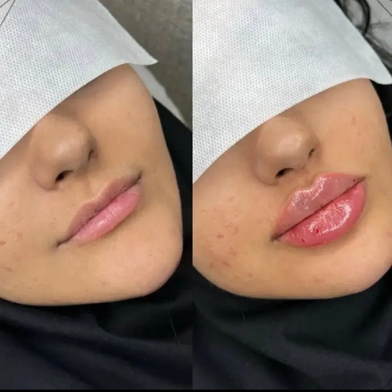 کلینیک زیبایی، خدمات ارایش دائم،ژل لب،چانه، گونه، زاویه،  بوتاکس و مزوژل ها و جوانساز،